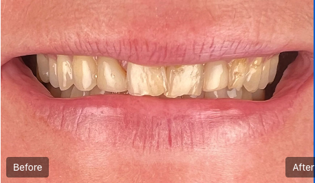Close-up of teeth before and after whitening, showing a brighter smile on the right.