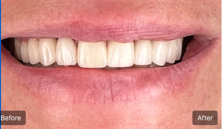 Close-up of a smiling mouth showing before-and-after teeth whitening comparison.