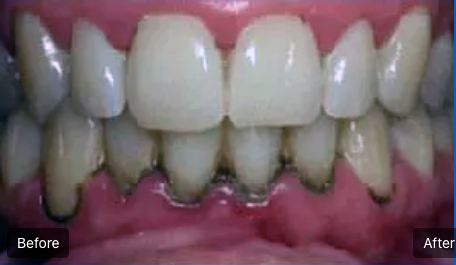 Before-and-after close-up of teeth, showing heavy staining removed in the after image.