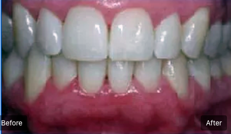 Side-by-side close-up of teeth and gums, labeled before and after treatment.