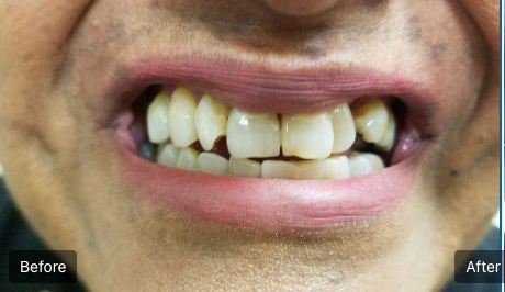 Close-up before-and-after of teeth whitening, showing stained teeth on the left and brighter teeth on the right.