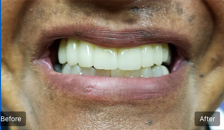 Close-up of a smile showing teeth, with “Before” and “After” labels on either side.