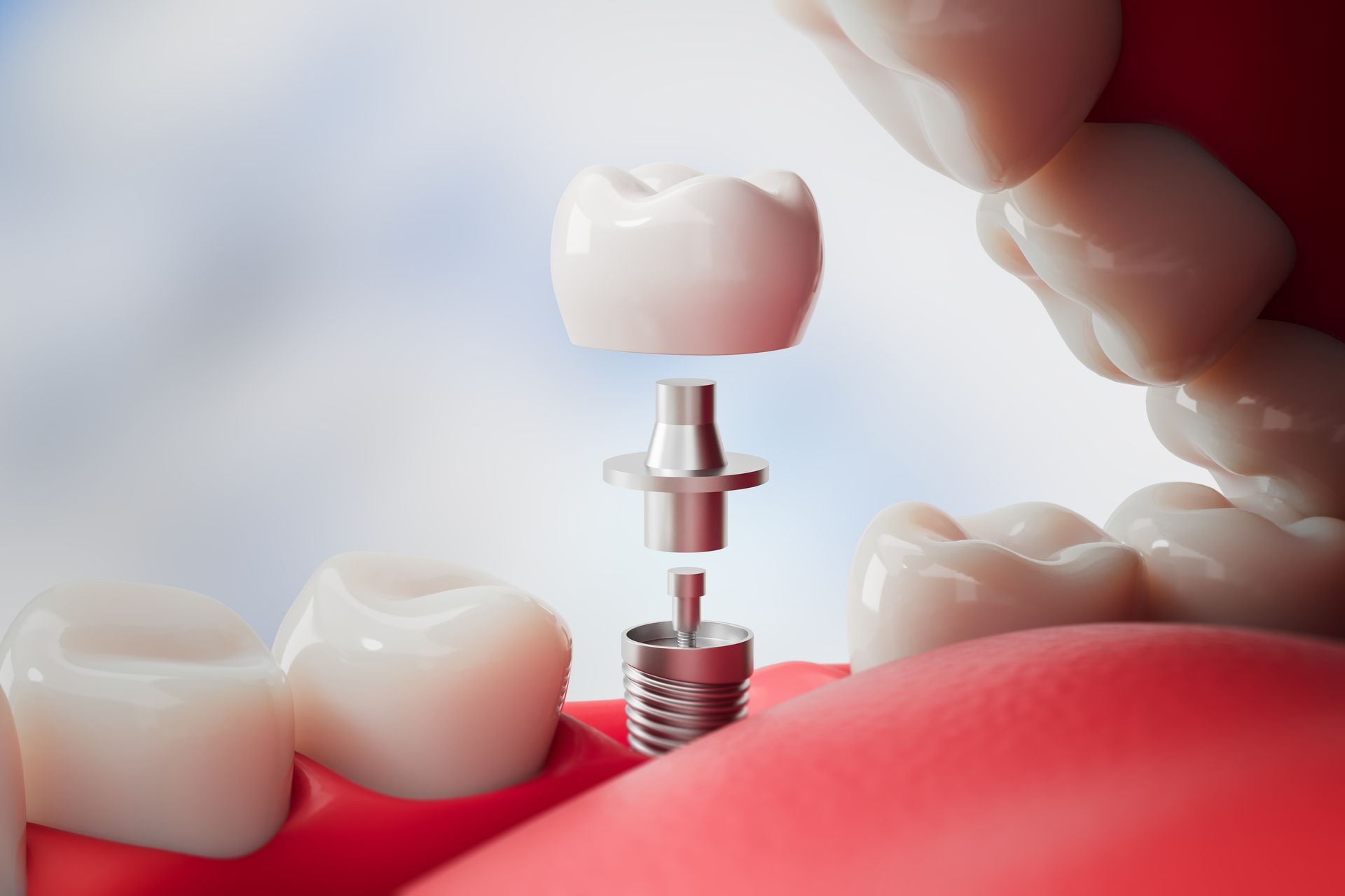 Dental implant being placed into a red gum with a tooth crown above it