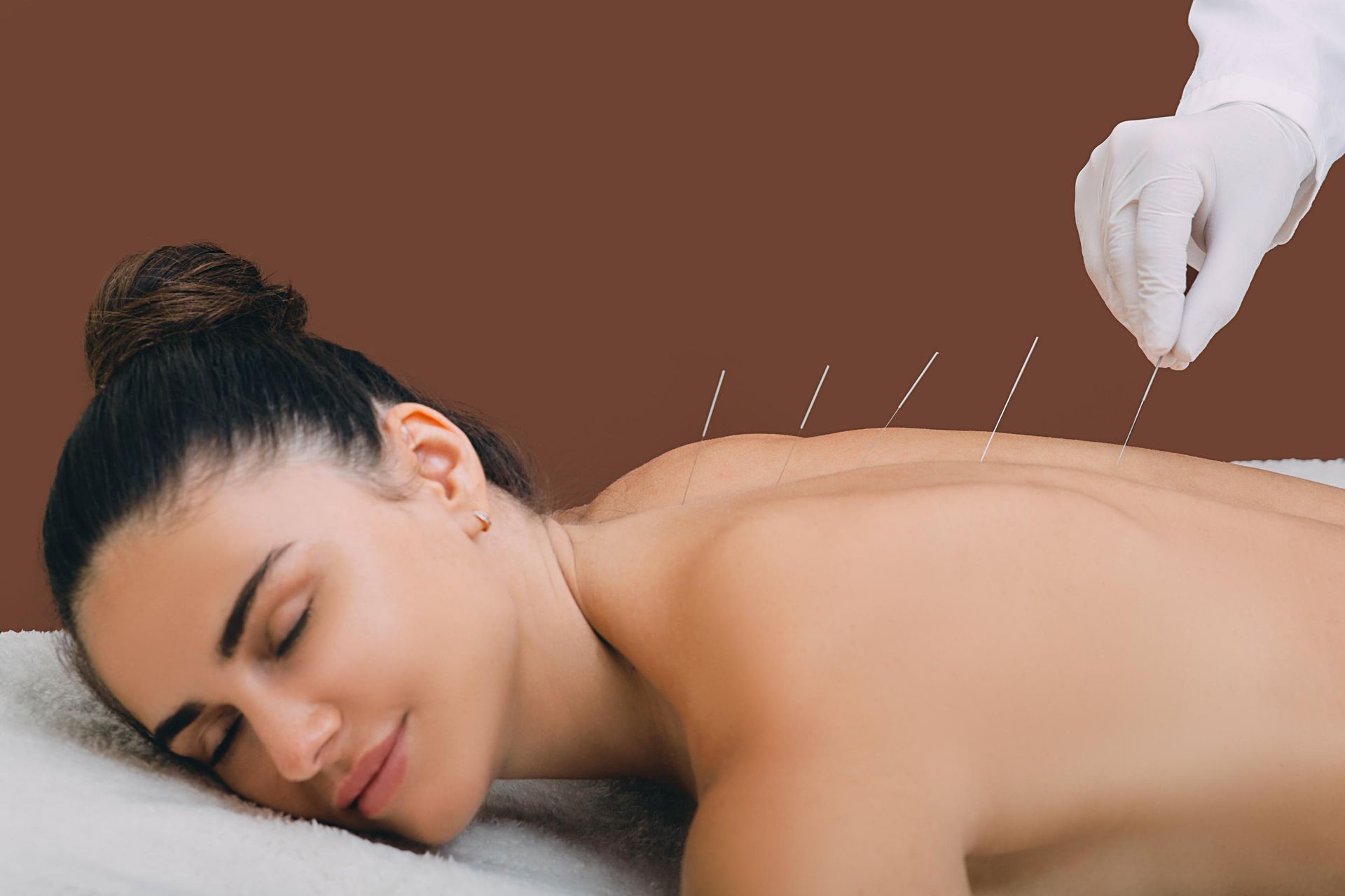 A Woman is Getting an Acupuncture Treatment on Her Back — Scott Martin Acupuncture Mackay In Cannonvale, QLD