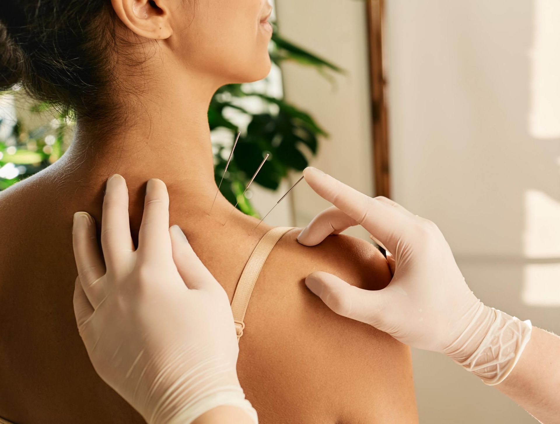A Woman is Getting Acupuncture on Her Shoulder — Scott Martin Acupuncture Mackay In Cannonvale, QLD