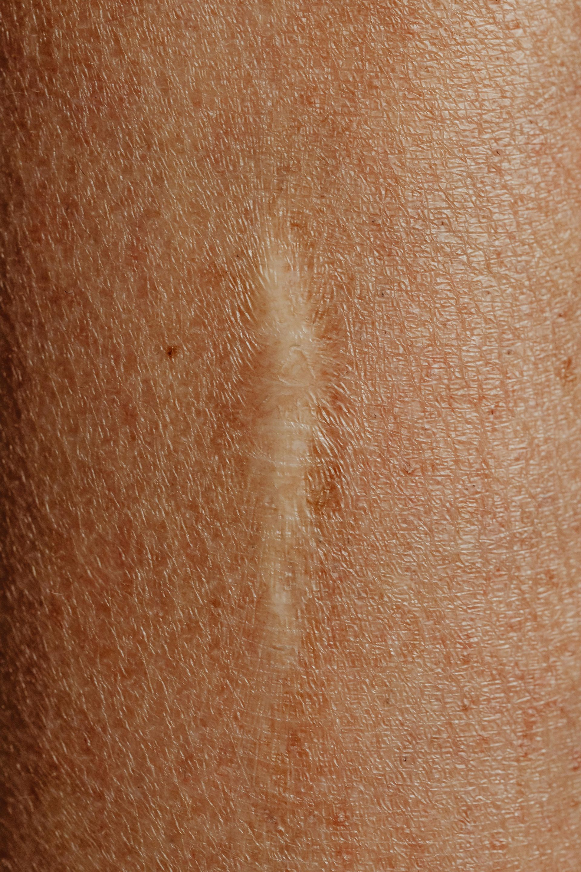 Close-up of skin with a thin, pale vertical scar or mark in the center.