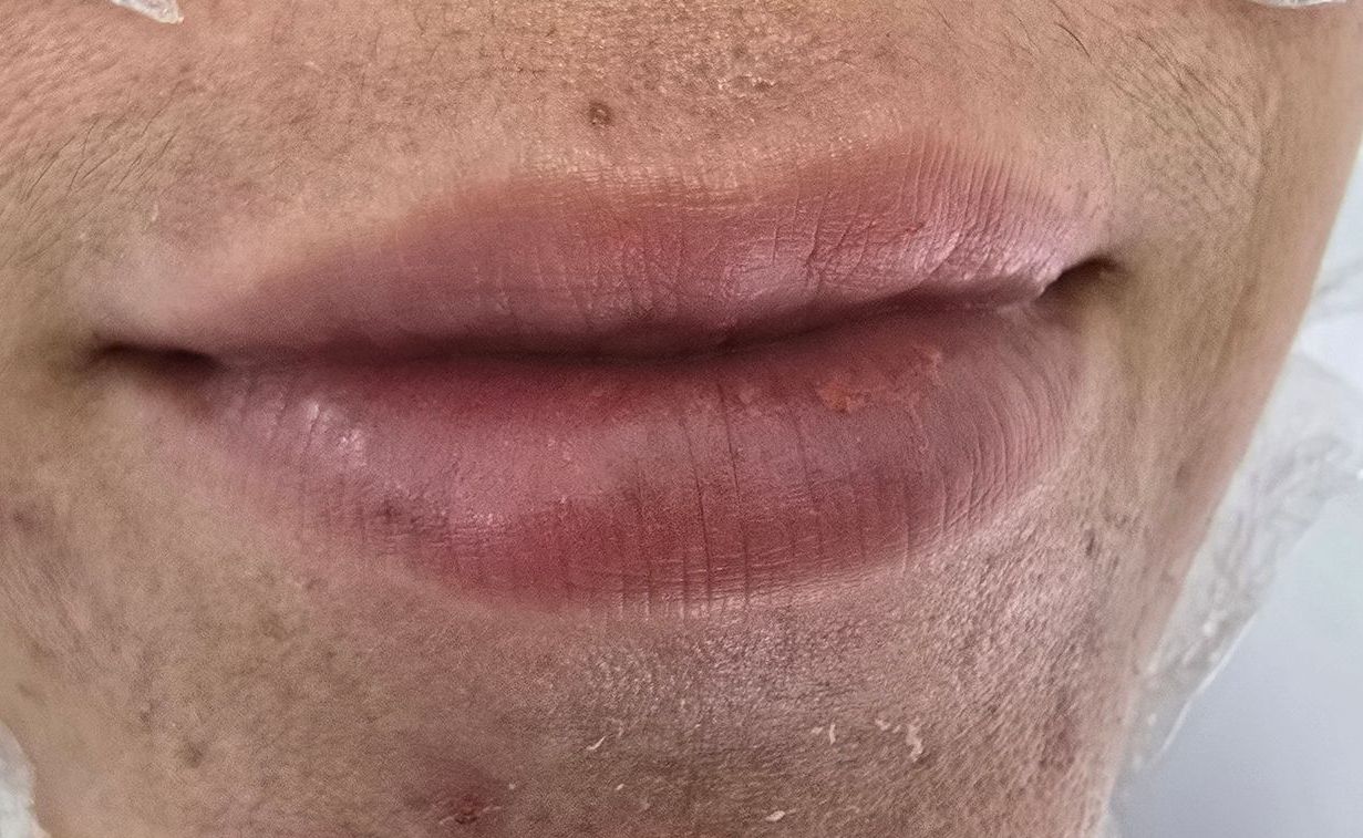 Primer plano de los labios de una persona; están rojizos y ligeramente hinchados, con piel rodeando la boca.
