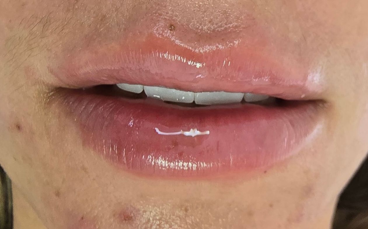 Primer plano de los labios de una persona, brillantes por el brillo labial. De color rosa claro, con dientes visibles. Algunas imperfecciones alrededor de la boca.