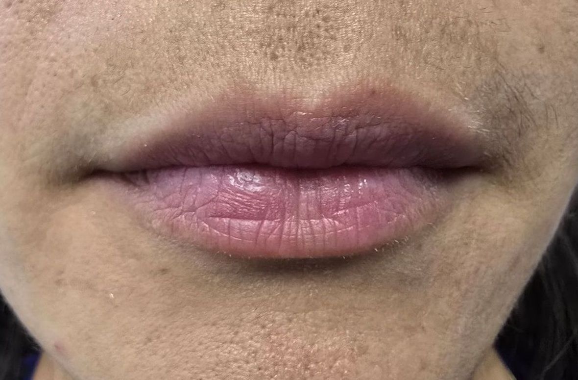 Primer plano de los labios de una persona; los labios tienen un tono púrpura y están agrietados.