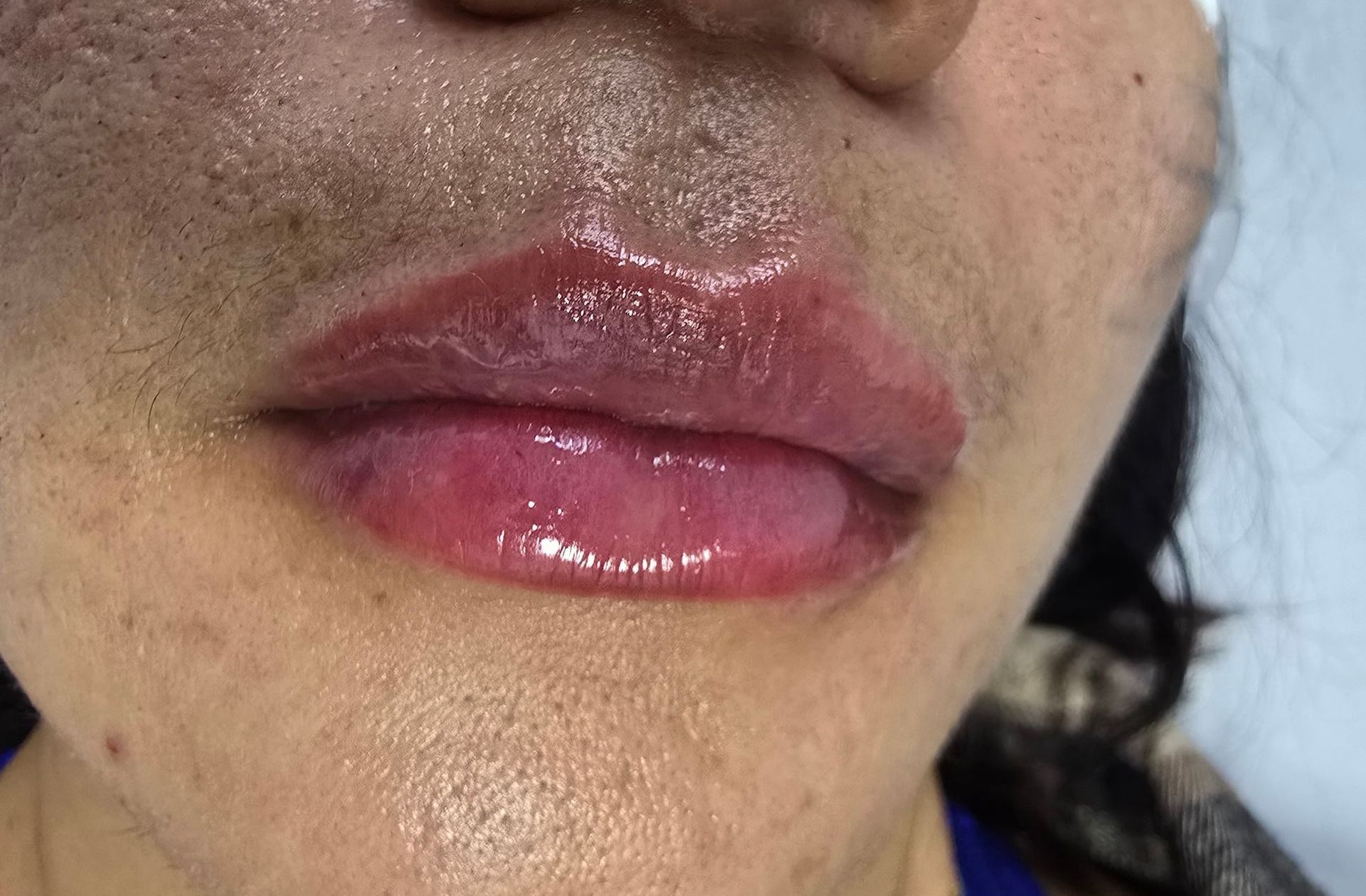 Primer plano de los labios de una persona, ligeramente brillantes, con un tono rosa-morado. La piel alrededor de los labios presenta algunas manchas oscuras.