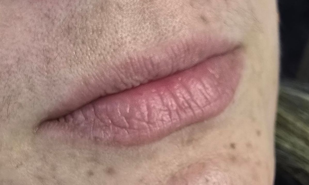 Primer plano de los labios de una persona, mostrando piel seca y líneas de expresión. Se ven algunas pecas en la piel adyacente.