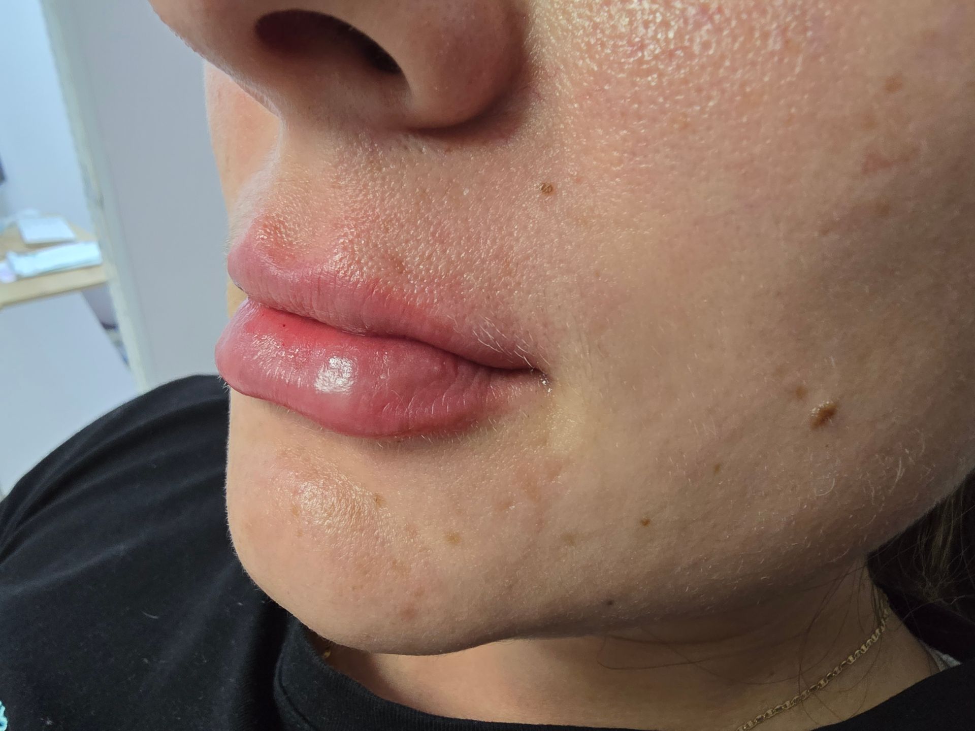 Primer plano de los labios y la cara de una persona; los labios están visiblemente hinchados, probablemente después de un procedimiento.