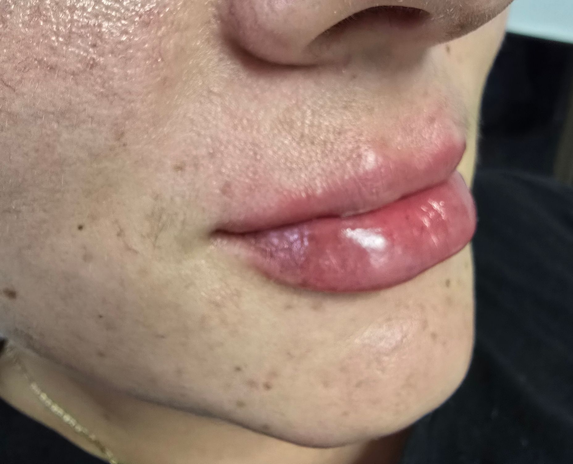 Primer plano del rostro de una persona: los labios se ven carnosos y ligeramente rojos. La piel presenta pecas y vello facial.