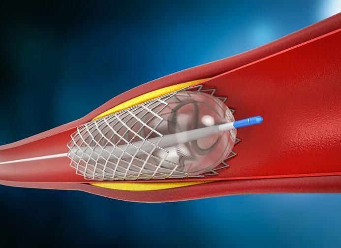 ANGIOLOGÍA Y CIRUGÍA VASCULAR DR. ERNESTO PACHECO P