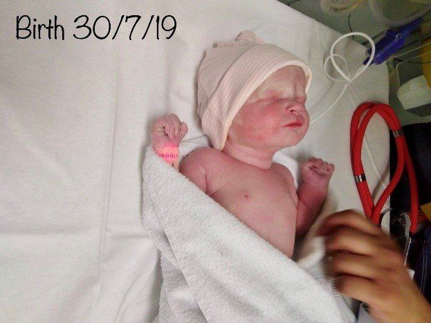 A newborn baby with Prader-Willi Syndrome wrapped in a white hospital blanket