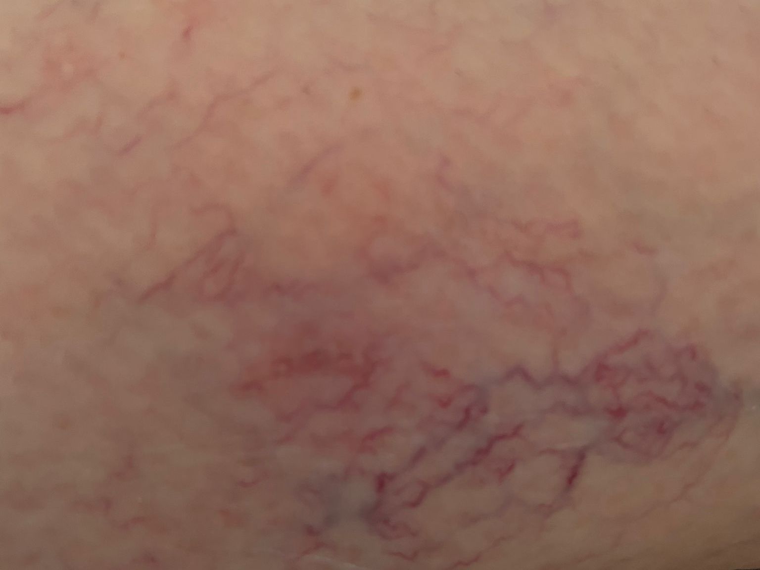 Leg vessels