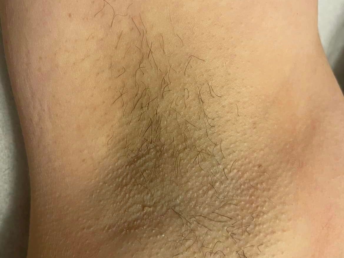 Laser hair removal