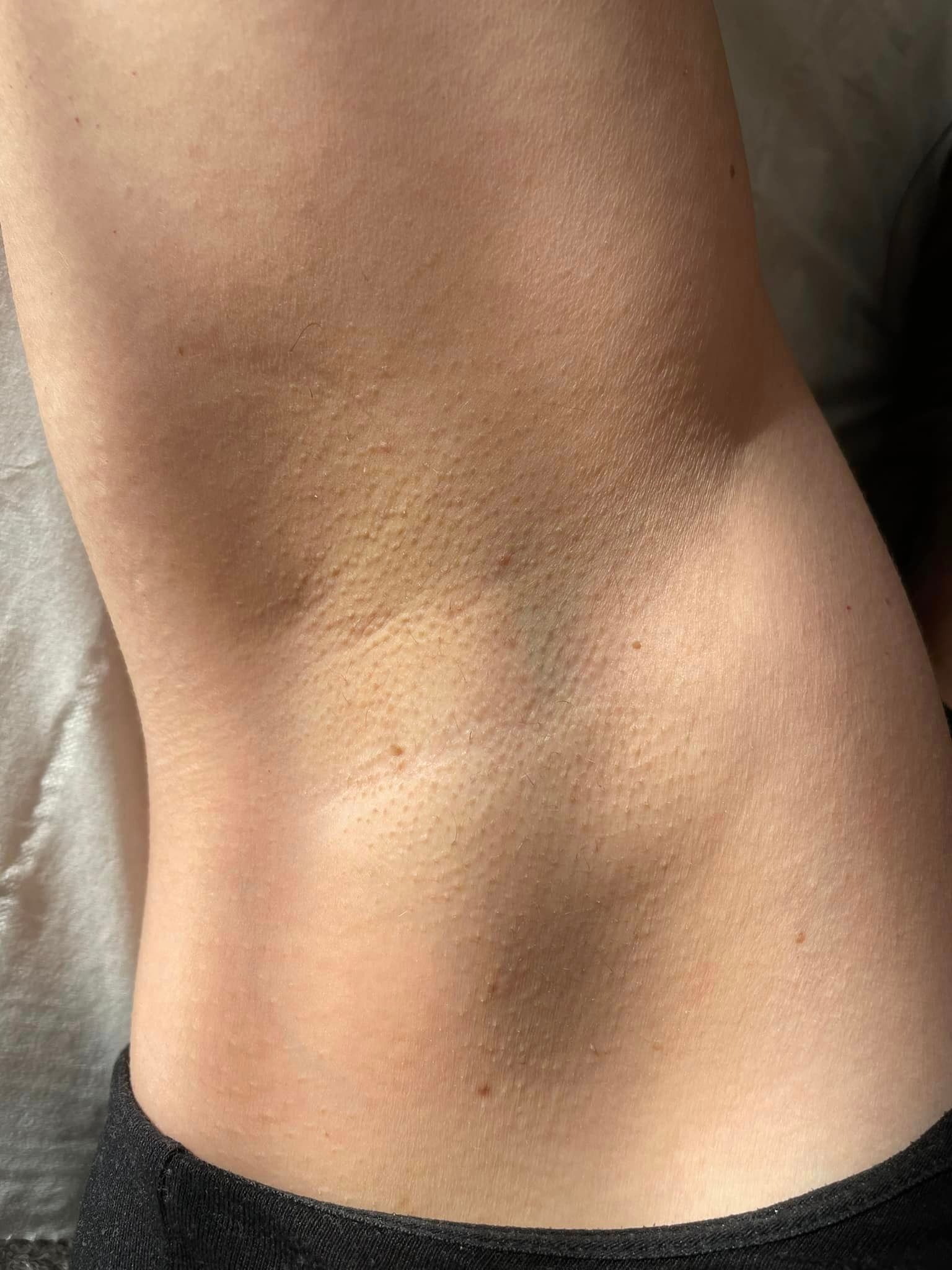Laser hair removal