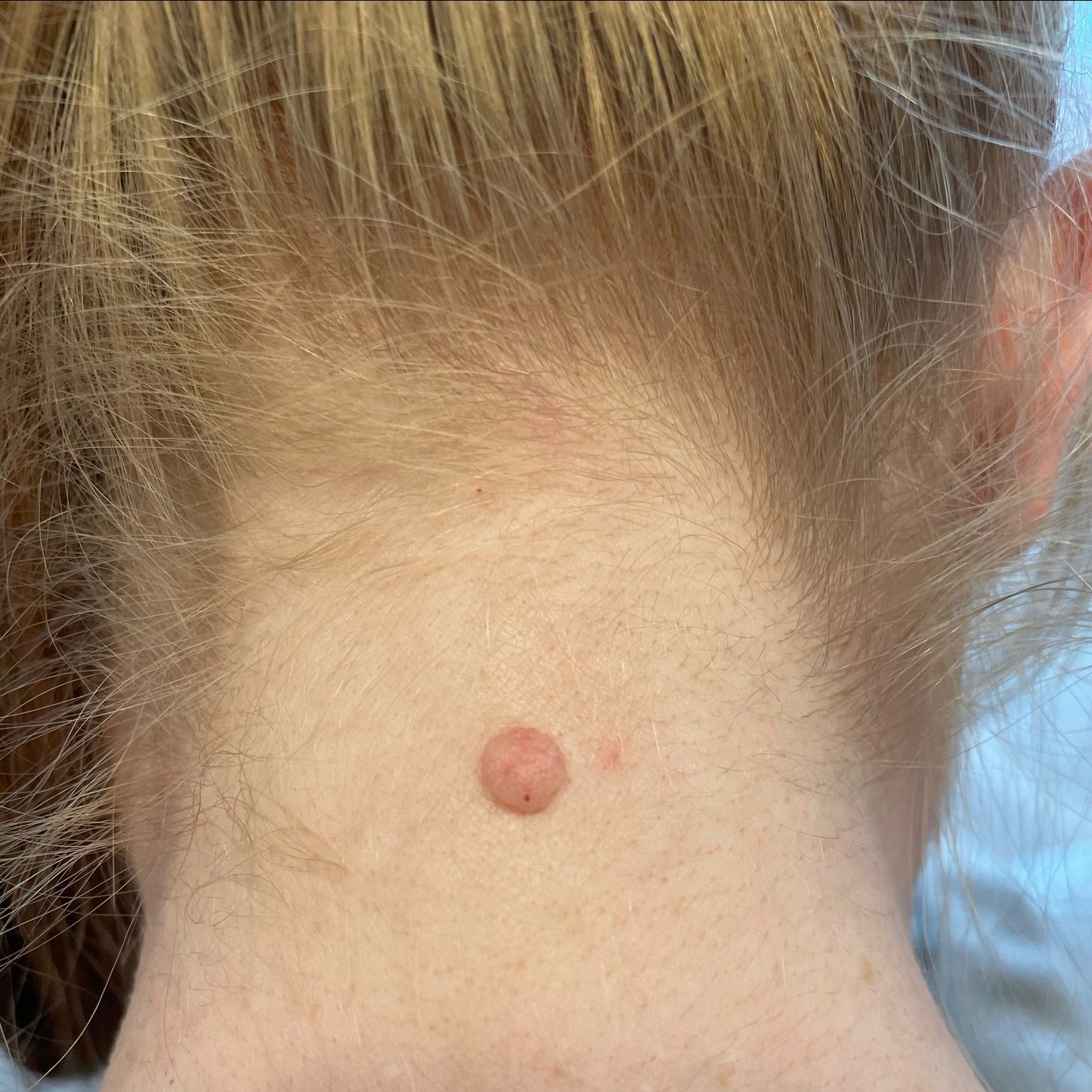 Skin tag removal