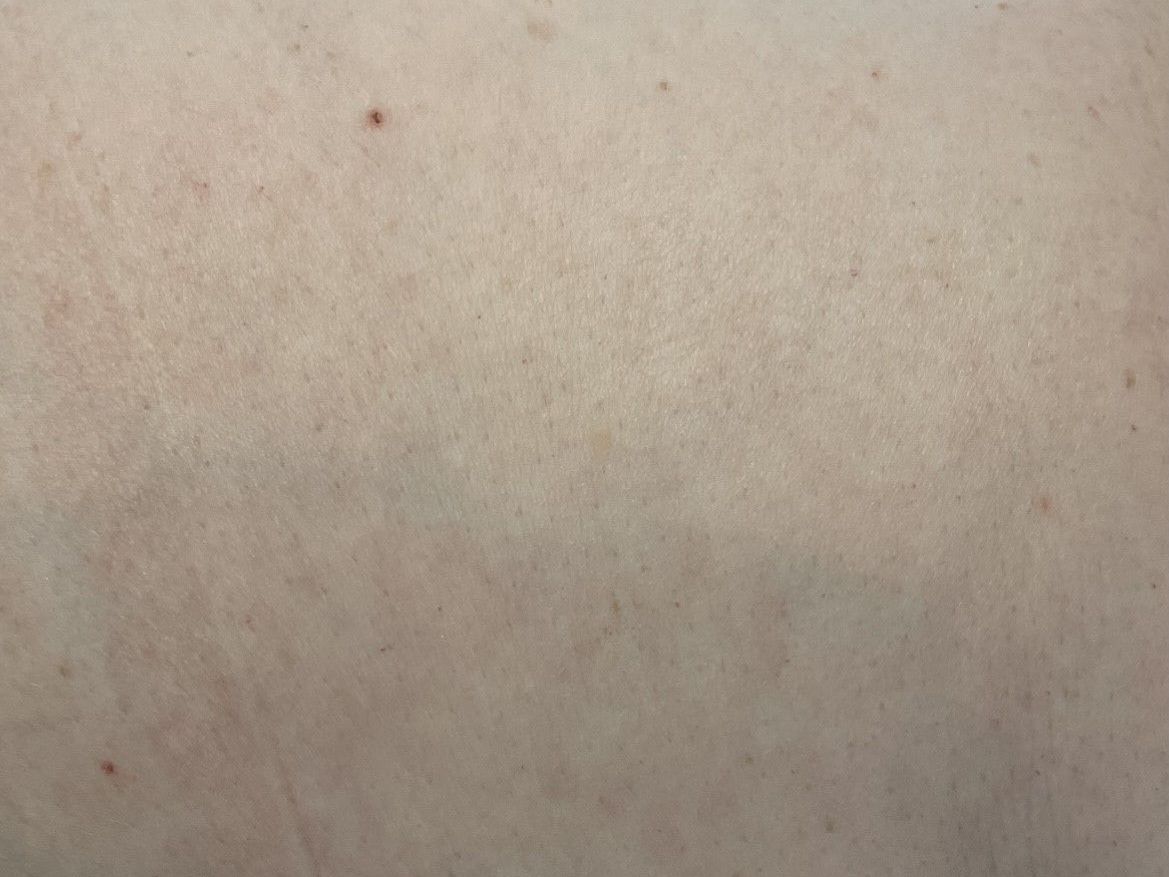 Cherry Angioma