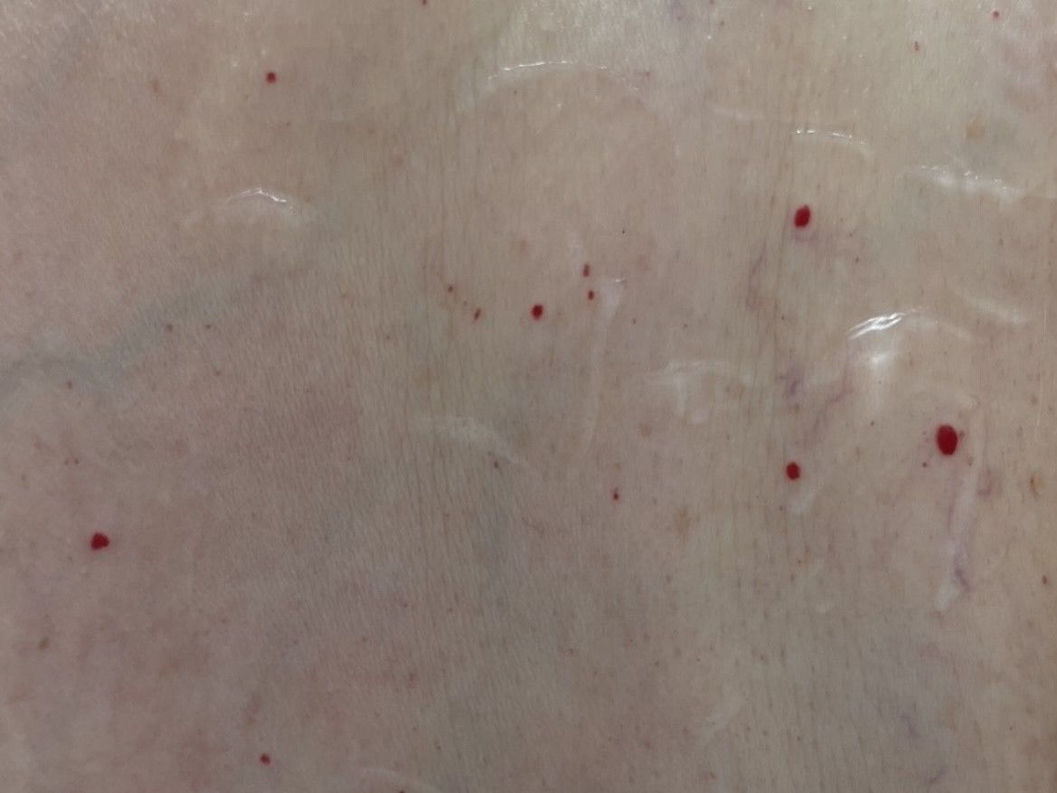 Cherry Angioma