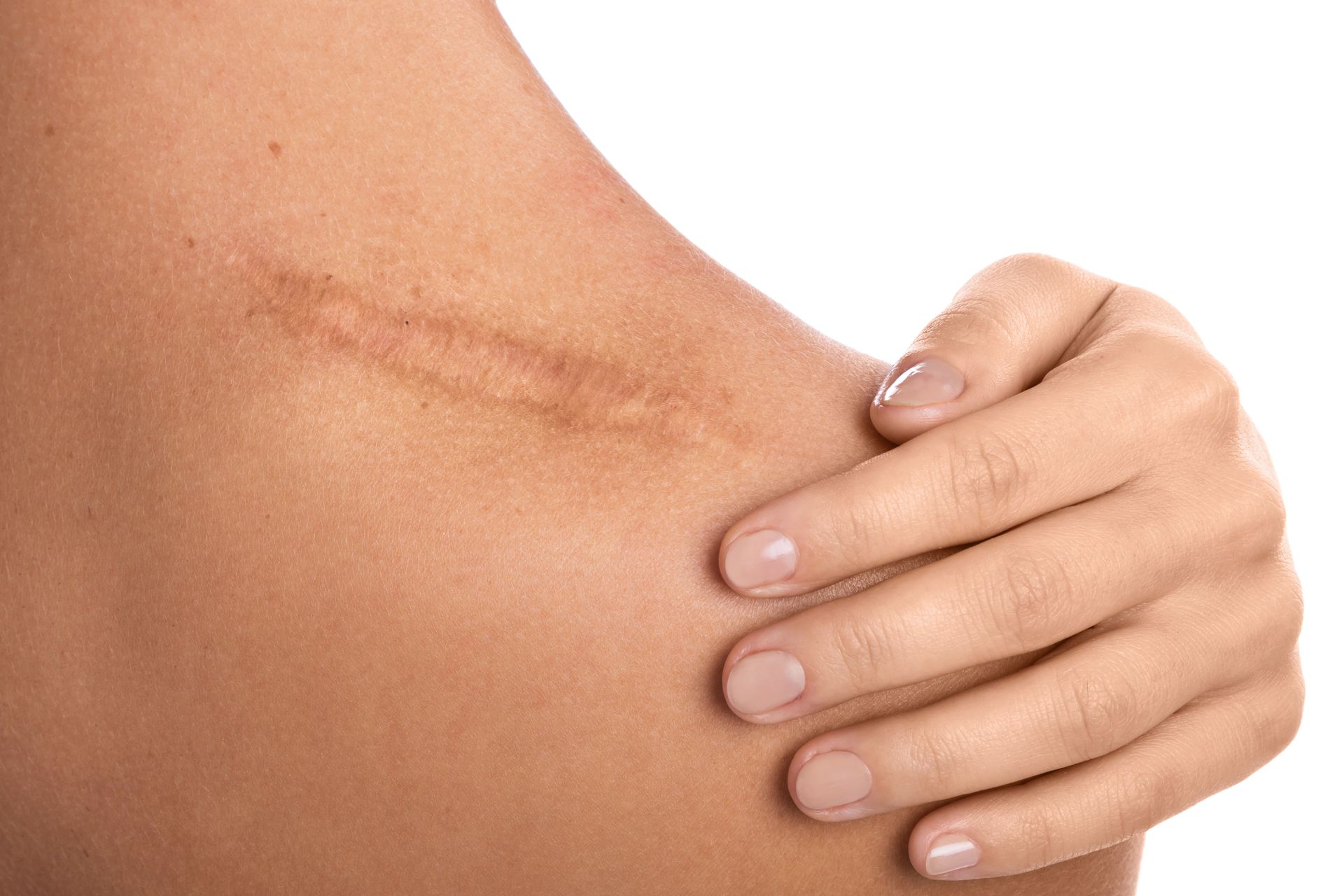 Scarring & stretch marks