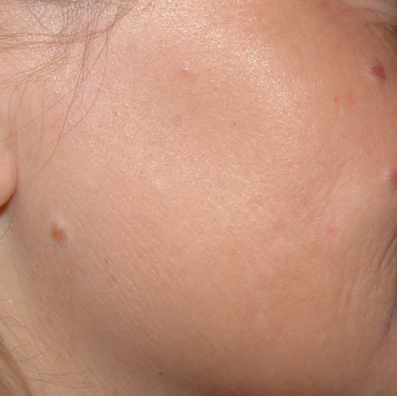 Skin pigmentation