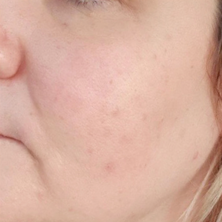 laser treatments for acne