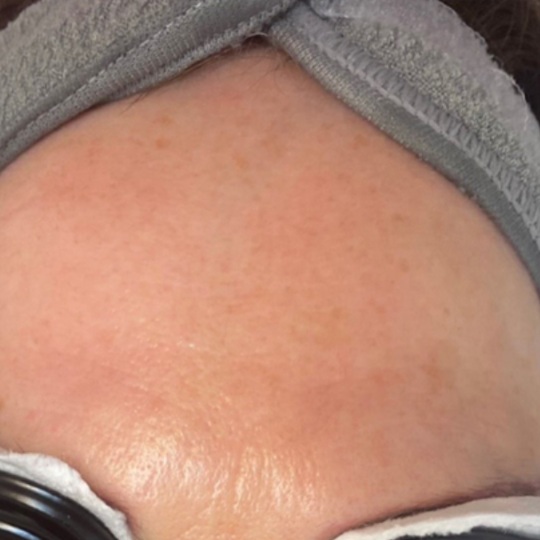 Skin rejuvenation