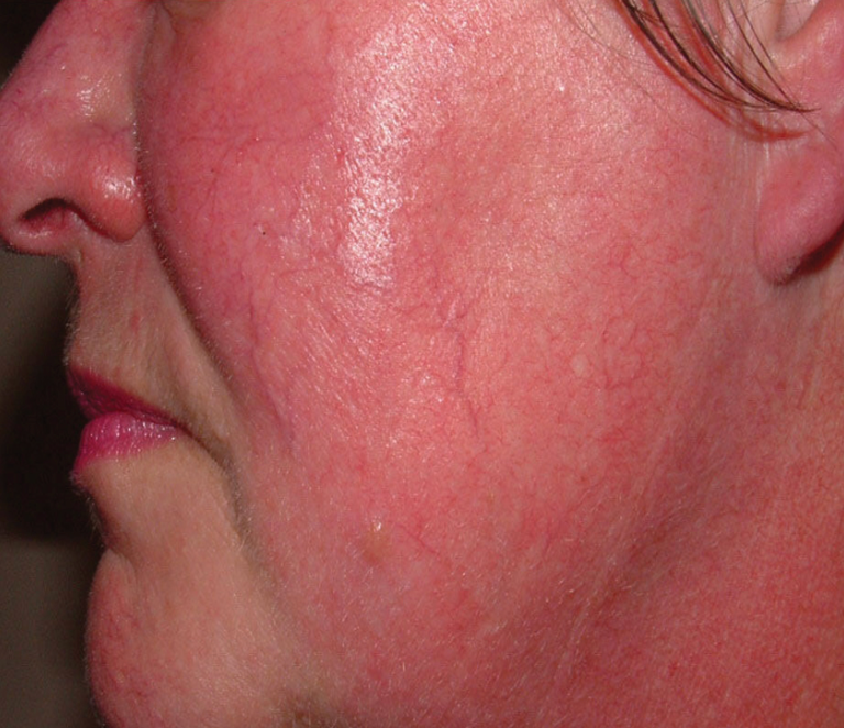 Rosacea (Facial Vessels)