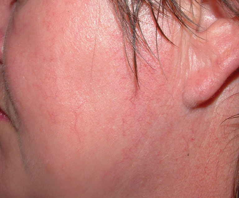 Rosacea (Facial Vessels)