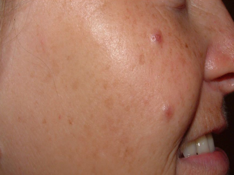 Skin pigmentation