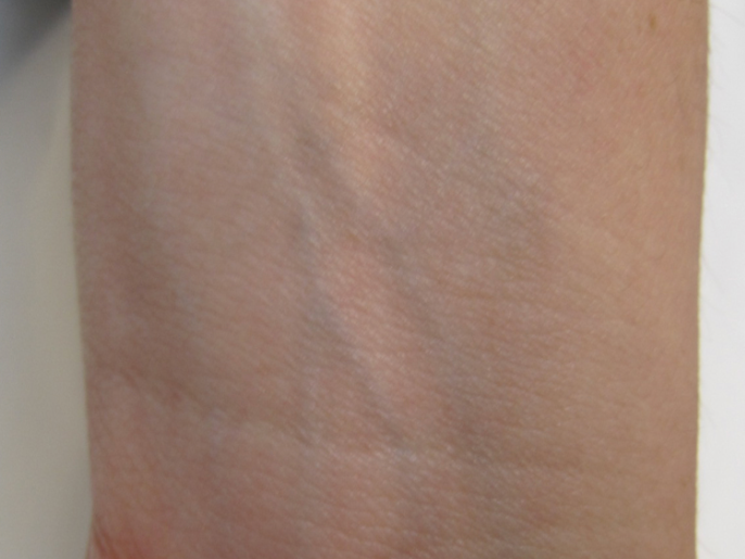 Laser tatto removal