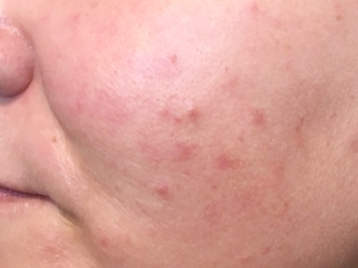 laser treatments for acne