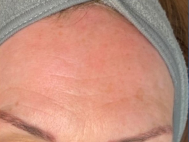 Skin rejuvenation