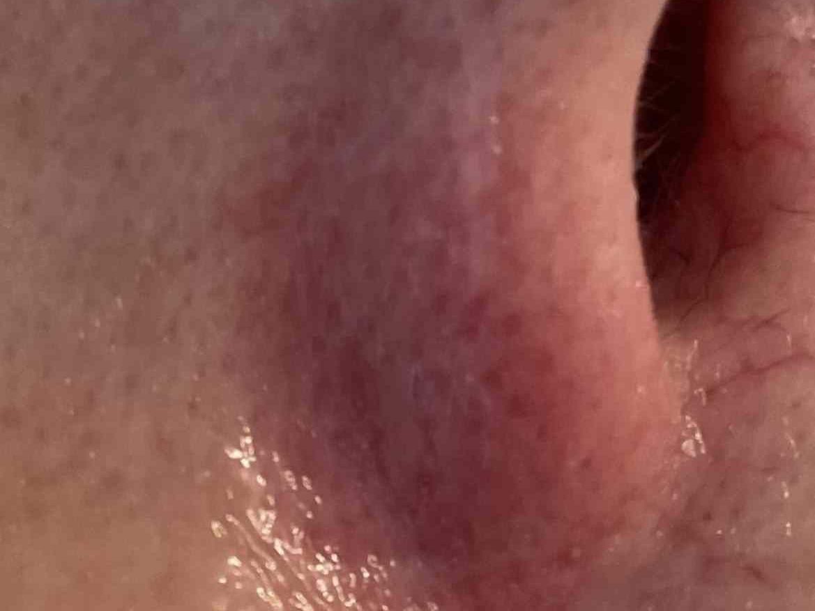 Thread Veins & Spider Naevus