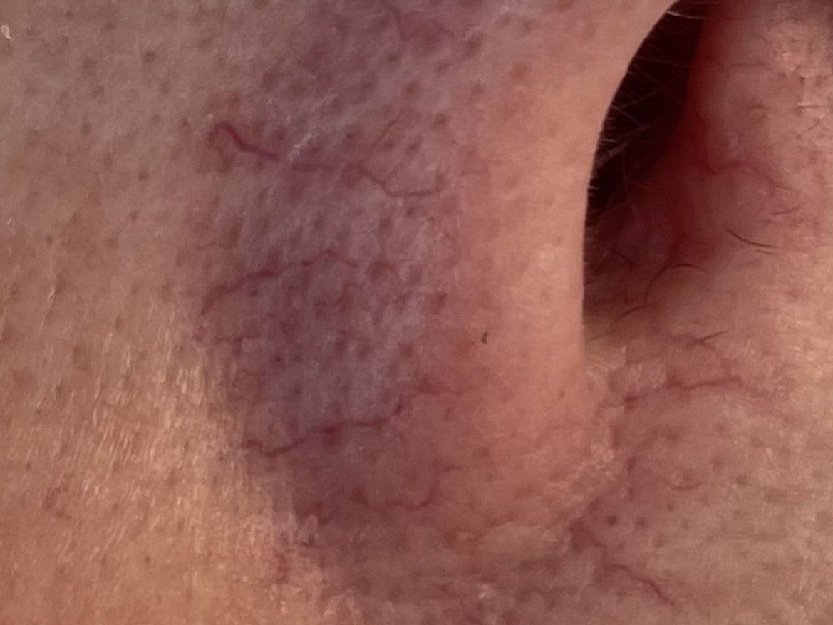 Thread Veins & Spider Naevus