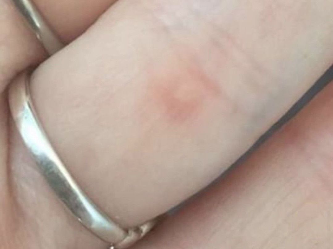 Warts