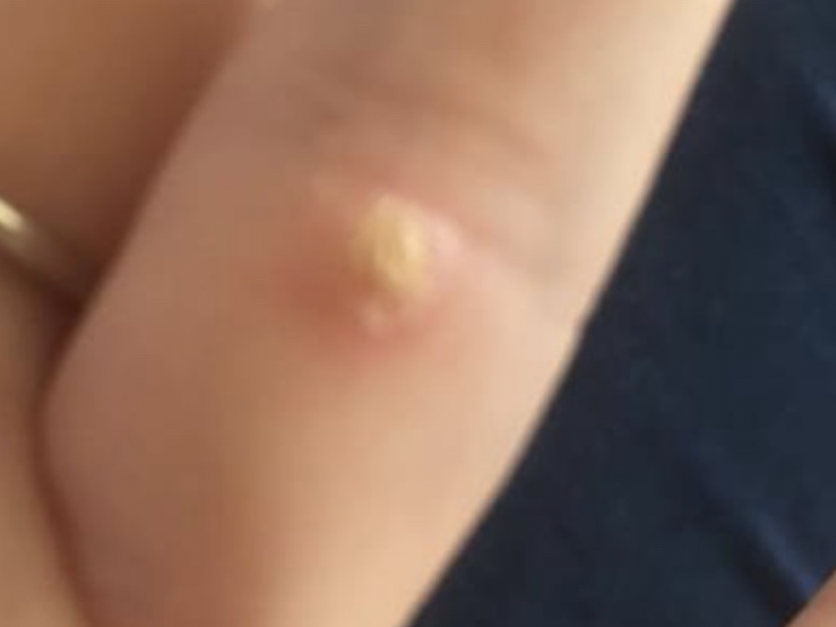 Warts