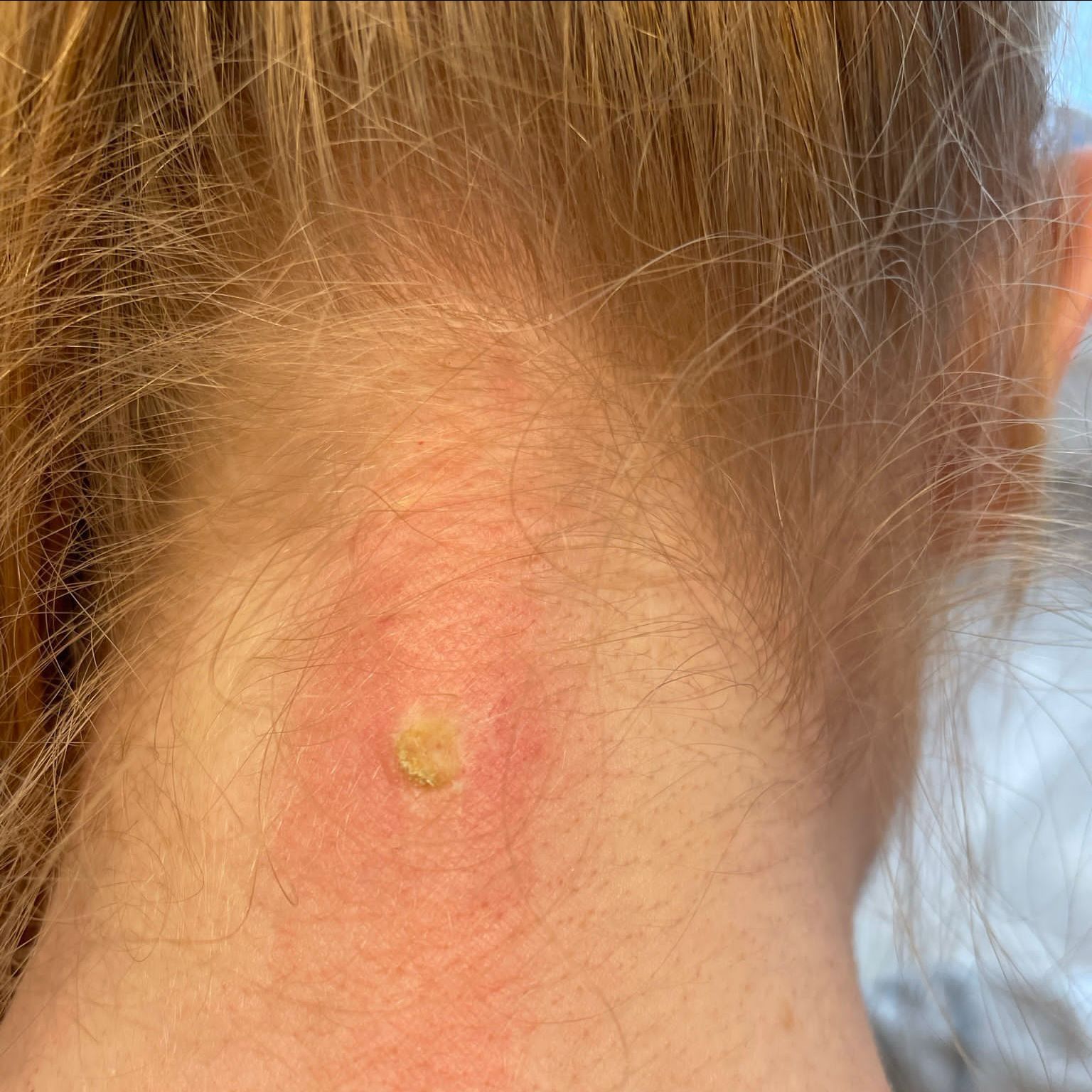 Skin tag removal