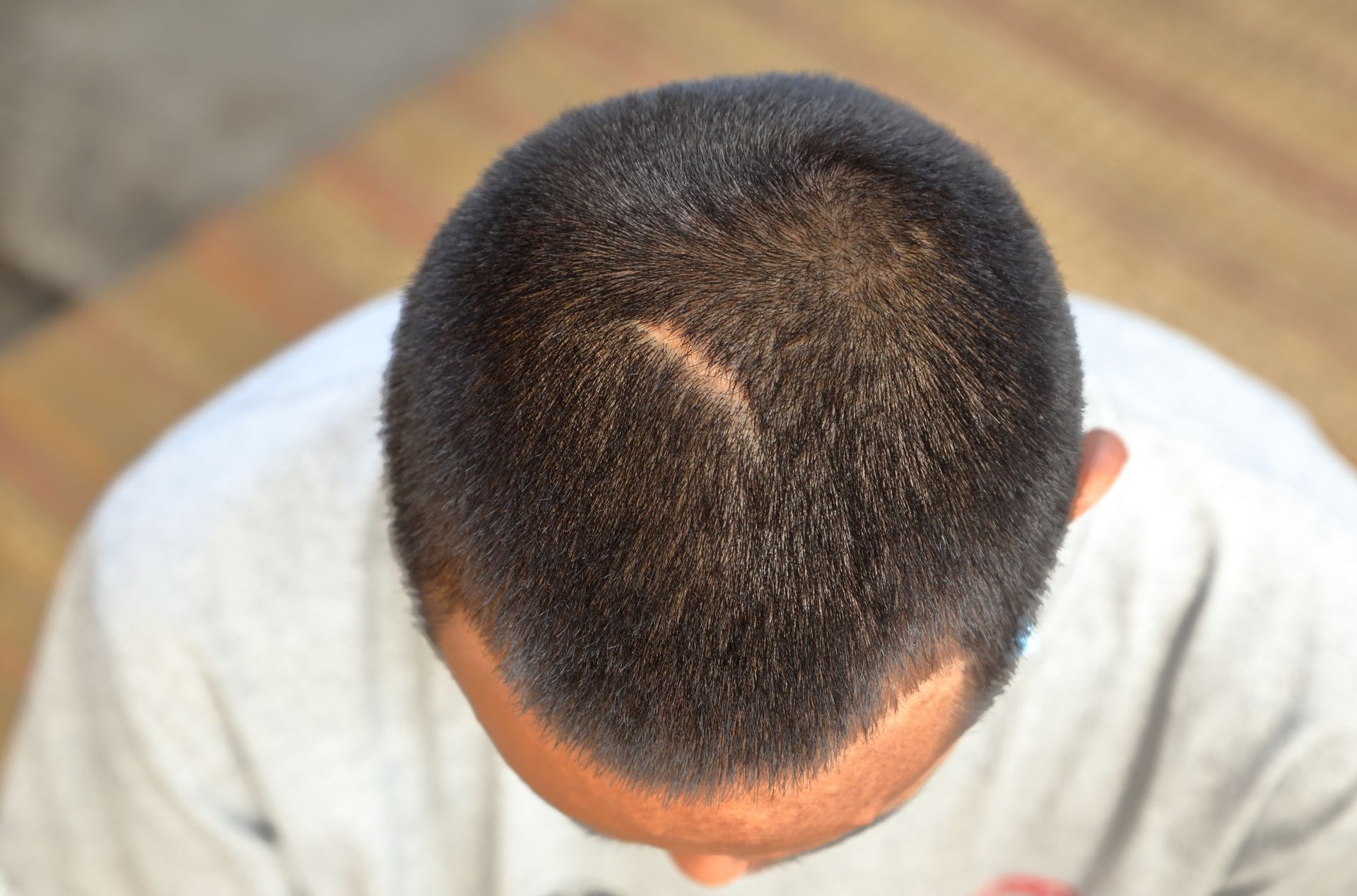 Scalp Scars Treatment Debary FL