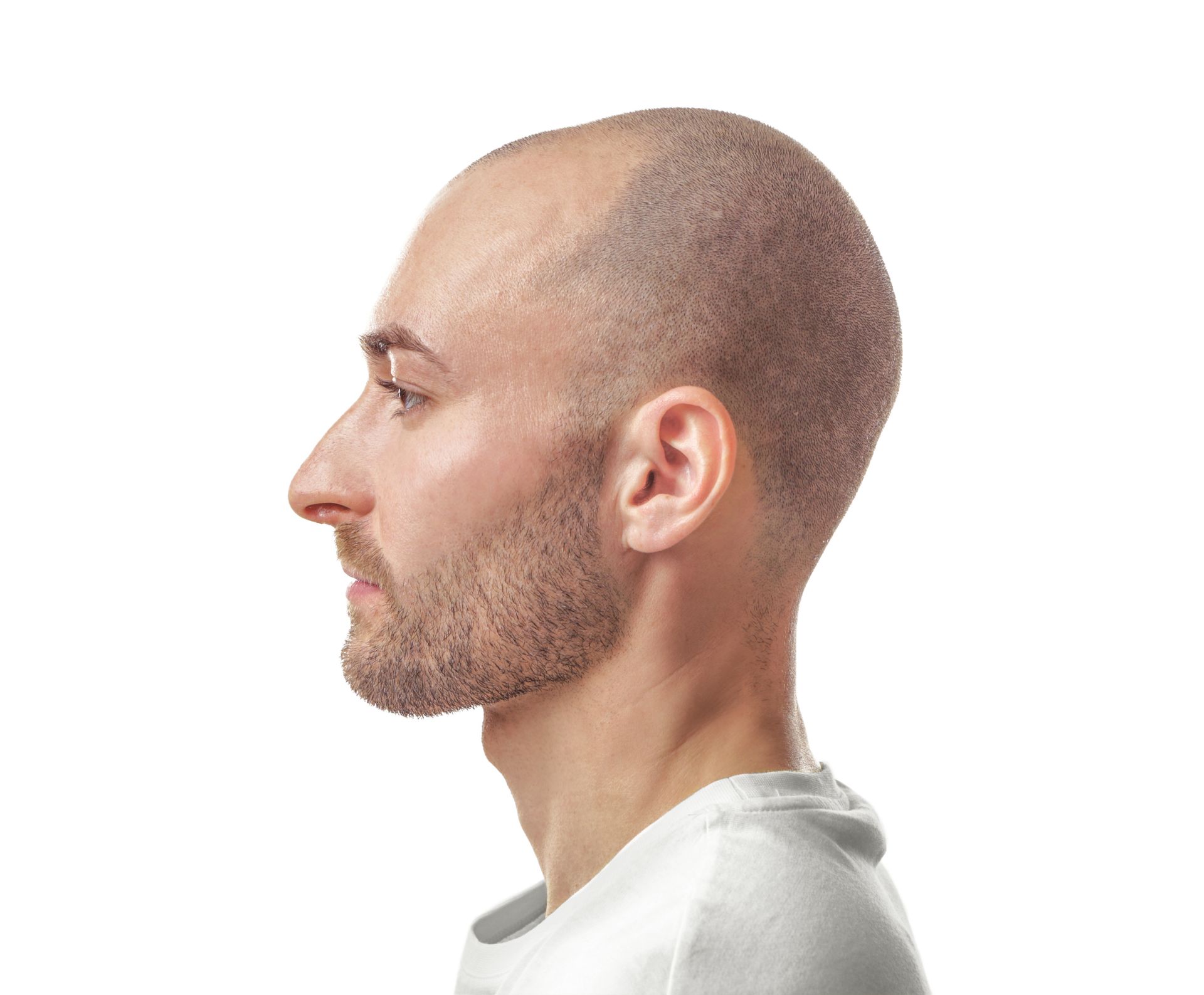 Moderate Hair Loss Treatment Debary FL