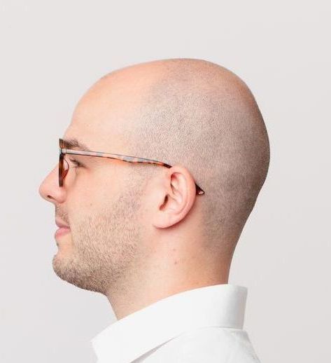 Advanced Hair Loss Treatment Debary FL