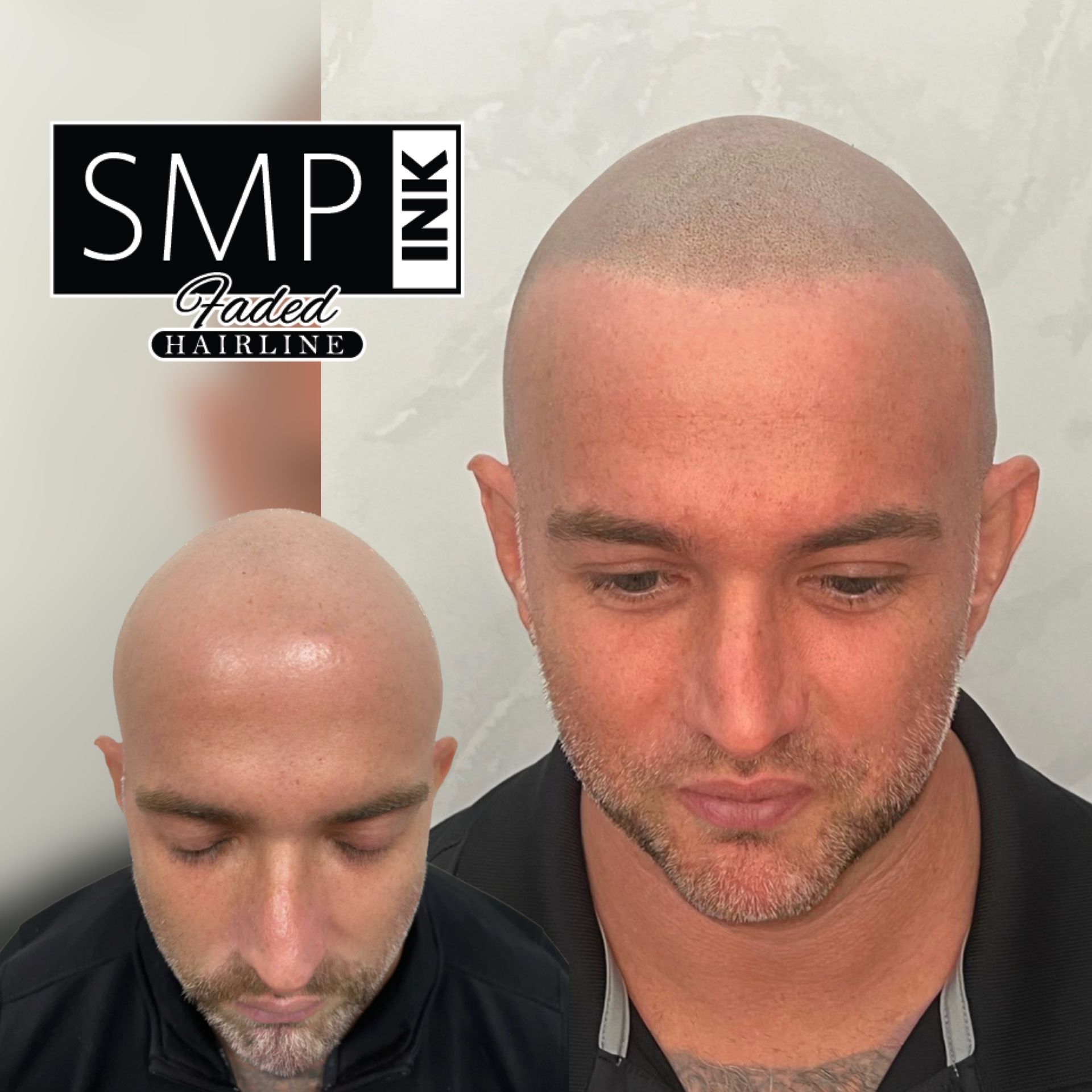 Before-and-after scalp micropigmentation showing a faded hairline and a shaved head with a fuller hairline effect