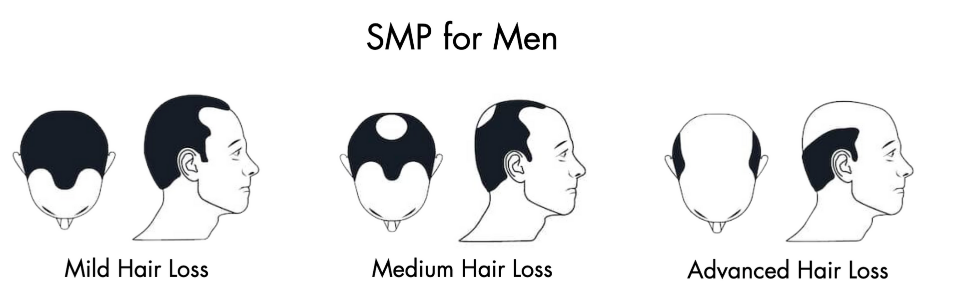 Three hair loss stages labeled mild, medium, and advanced, with front and side head views
