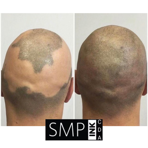 Back of a bald head before and after scalp micropigmentation treatment, side by side.