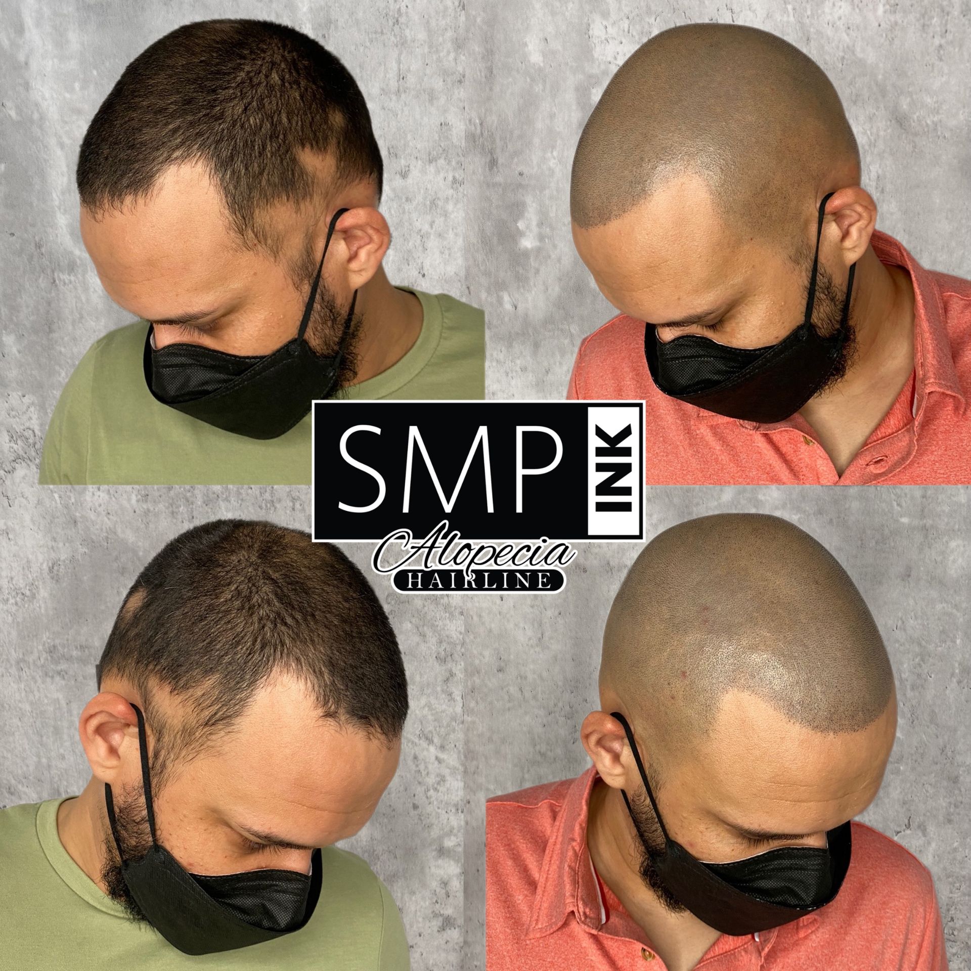 SMP hair tattoo before-and-after collage showing a shaved scalp with denser hairline shading