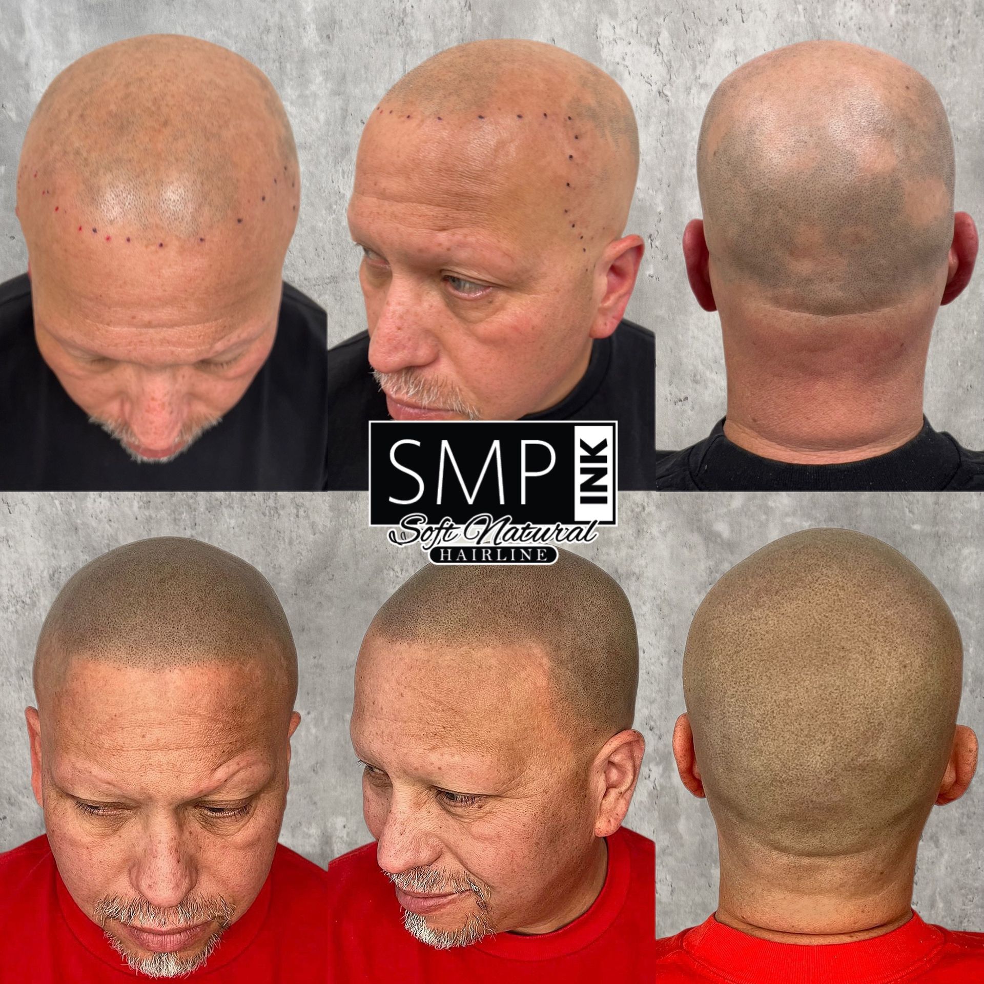 Six views of a shaved scalp before and after scalp micropigmentation on a black background.