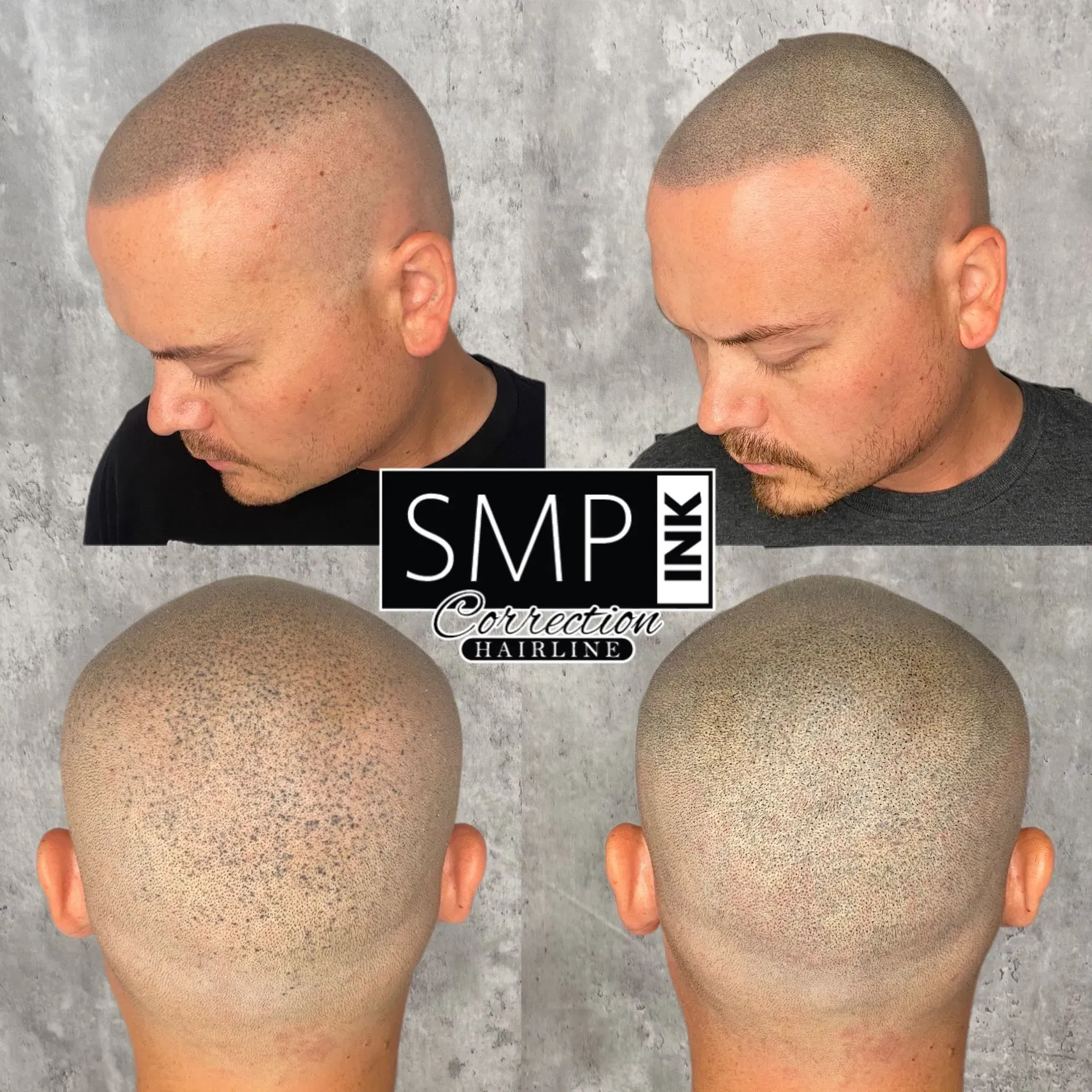 Before-and-after scalp micropigmentation on a shaved head, shown from side and back views.