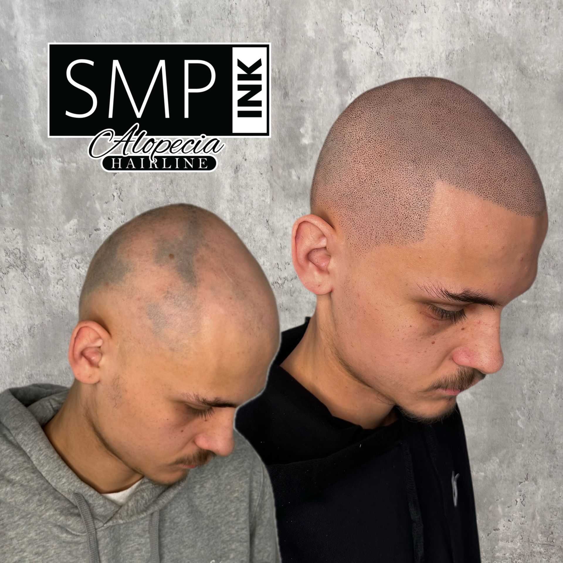 Before-and-after of a closely shaved head with SMP hairline treatment, showing a fuller look.